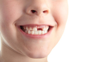 The Drawbacks of Missing Teeth