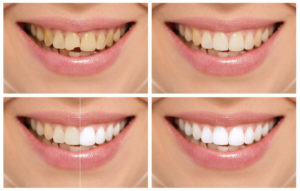 Reasons to Like Dental Bonding Procedure