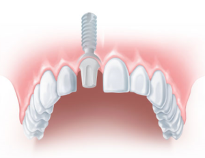 Fight Tooth Loss thru Dental Implants