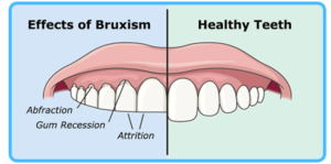 Teeth Clenching Facts of Bruxism