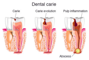 Dental Difficulties Related to Dental Abscess