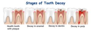 Who Carries Dental Caries